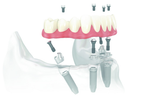 Restore your smile, with teeth in a day treatment from Lauren Becker DDS, PC 