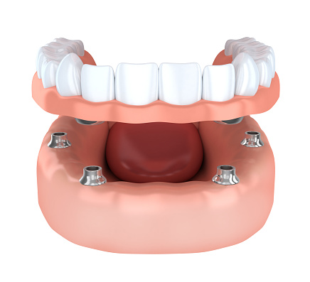 All-on-4 Treatment at Lauren Becker DDS, PC 