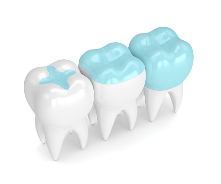 Composite fillings at New York, NY.