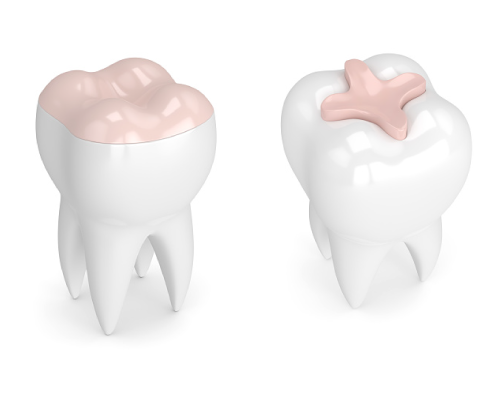 Dental inlays and onlays by dentistLauren Becker DDS, PC 